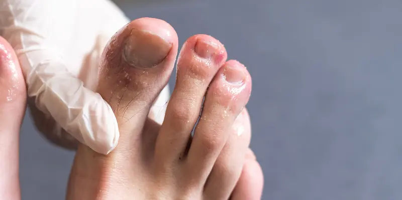 Understanding COVID Toes Causes and Symptoms